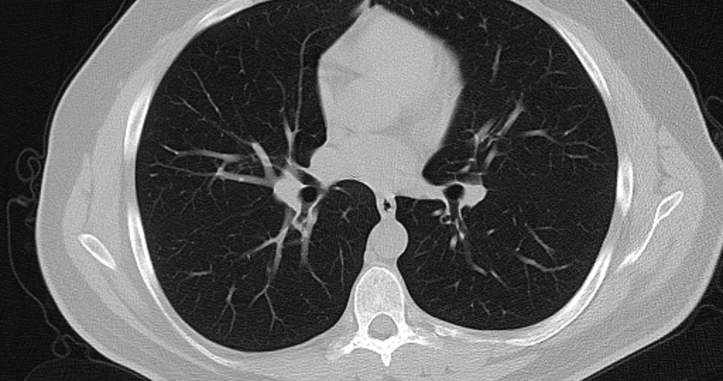 Axial CT scan of the thorax in lung window, showing both lungs, the airways and the vertebral body
