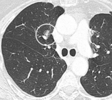 Axial chest CT showing a part-solid pulmonary nodule in the right upper lobe, ringed by a thin annotation circle